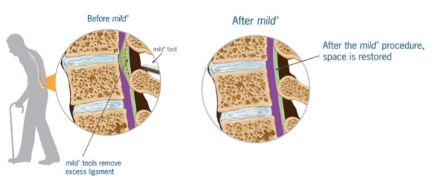 Spinal Stenosis - A Short Blog Post From Emed