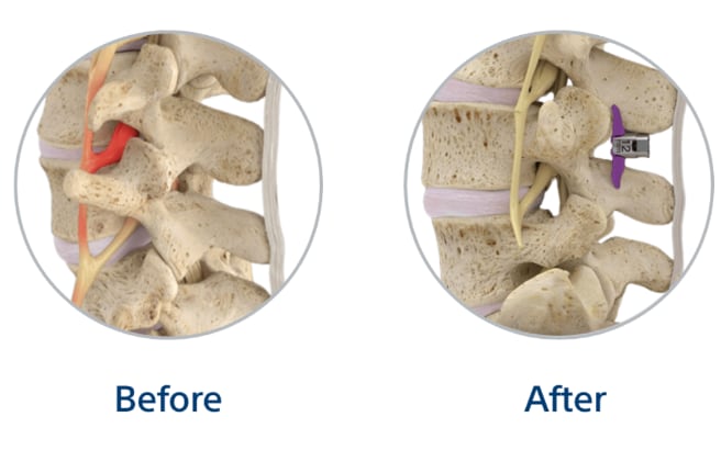 Vertiflex before and after